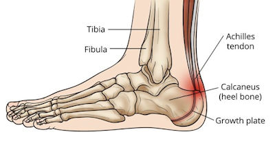 Out and About and Physical Fitness - Joint and Muscle Issues - Lower Limb Pain - Heel Pain photo